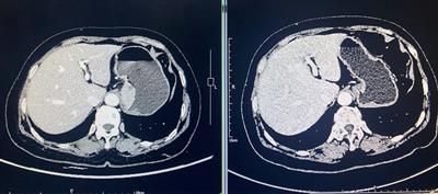 Cardiac tamponade, a rare complication of gastric cardia cancer resection after neoadjuvant chemotherapy combined with immunotherapy: a case report and literature review